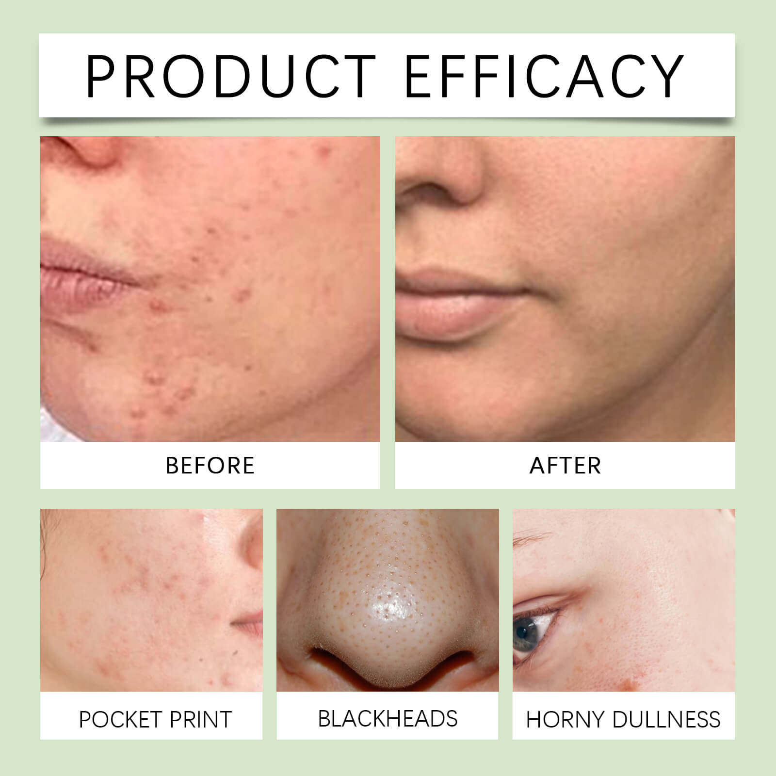 Azelaic Acid Clarifying Serum Oil Control, Acne & Blackhead Reduction, Hydrating & Smooth Skin (8)